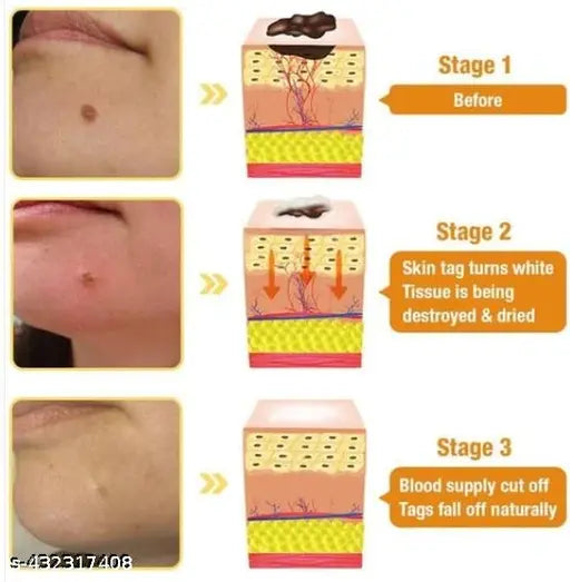 DermaSmooth Skin Tag Remover Patch – Fast, Safe & Painless Solution
